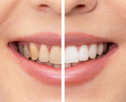 teeth whitening